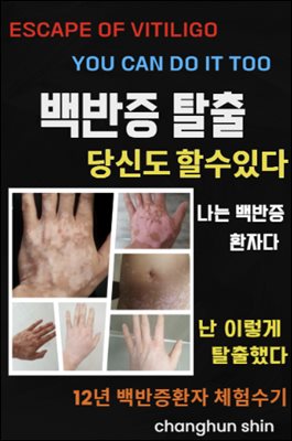 백반증탈출 당신도 할수있다